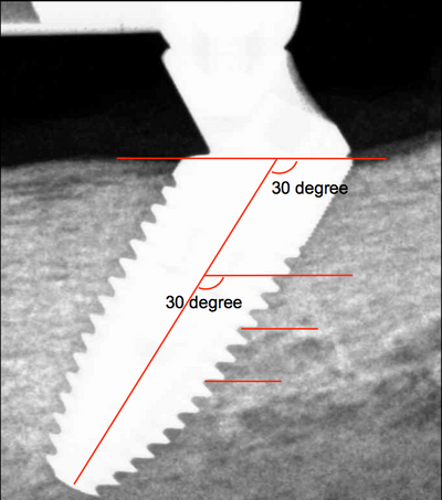 Loocid Implant In situ